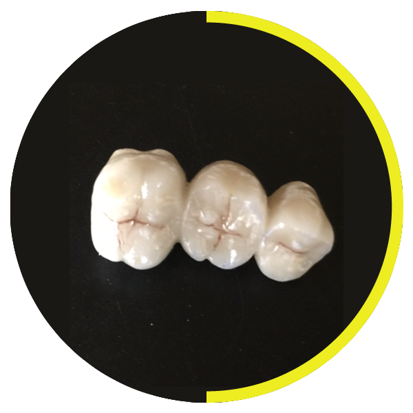 https://dentalartstudio.ca/wp-content/uploads/2023/07/Porcelain-Fused-Metal-DAS.png