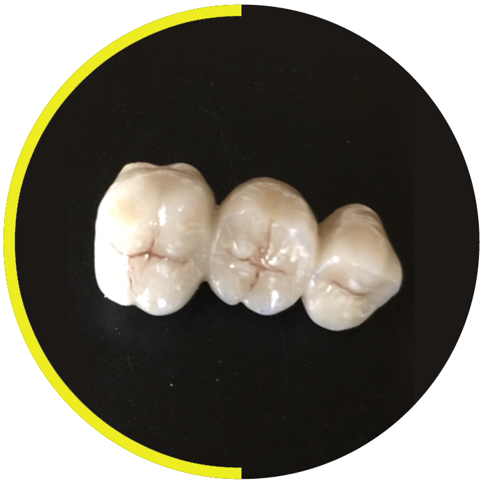 https://dentalartstudio.ca/wp-content/uploads/2023/07/banner-Porcelain-Fused-Metal-DAS.png